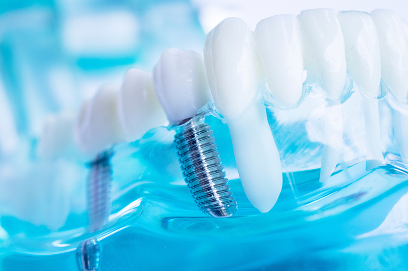 Downtown Parker Dental | Orthodontics, Sports Mouthguards and Night Guards