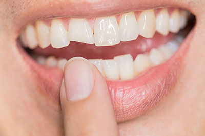 Downtown Parker Dental | Veneers, Cosmetic Dentistry and ZOOM  Whitening