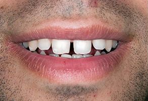 Downtown Parker Dental | Dentures, Oral Cancer Screening and Teeth Whitening